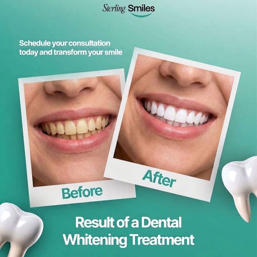 Sterling Smiles whitening treatment visual